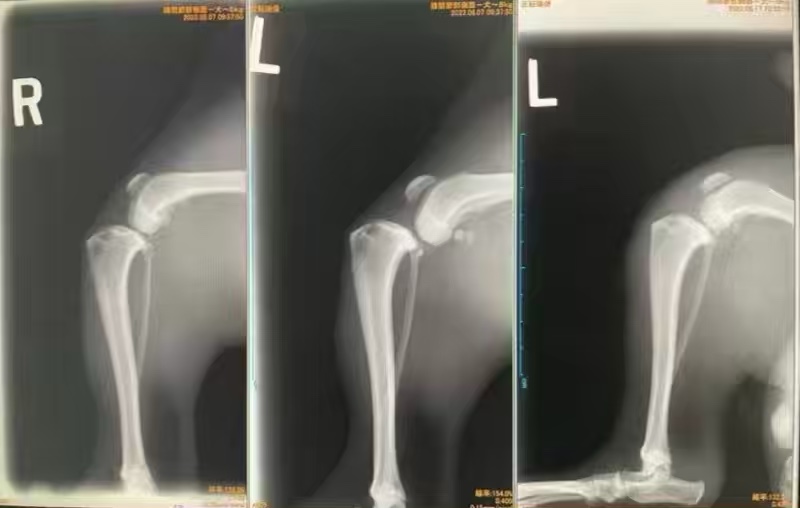 膝蓋骨内包脱臼(MPL)と前十字靭帯断裂